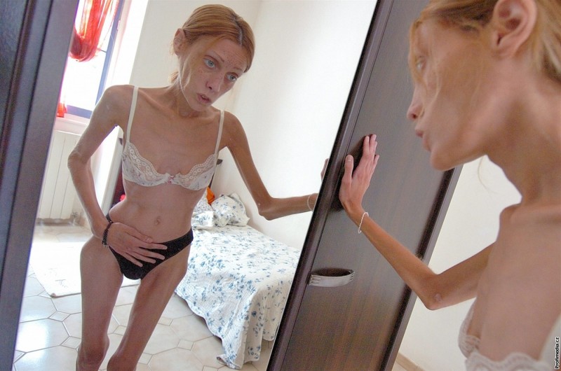 Health: 10 Most Terrible Cases of Anorexia!